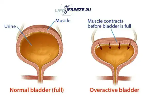 diagram of overactive bladder treatment Merthyr Tydfil
