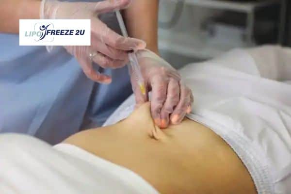 How Does Aqualyx Fat Dissolving Injection Work to Break Down Fat Merthyr Tydfil?