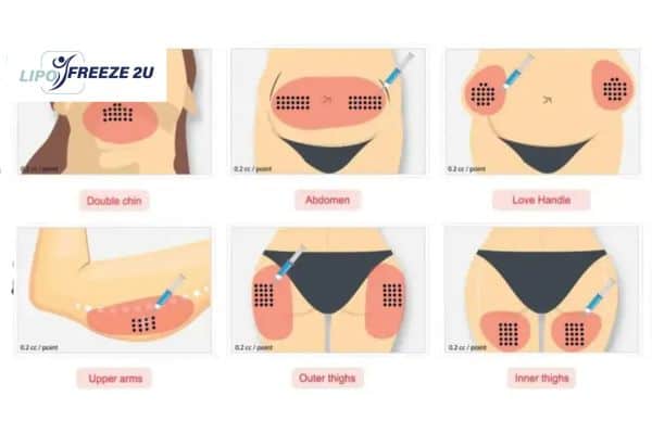 Benefits of Choosing Aqualyx for Fat Reduction Merthyr Tydfil