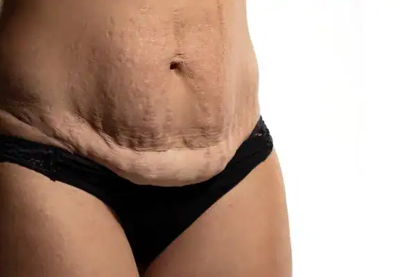 loose skin after weight loss injections Merthyr Tydfil