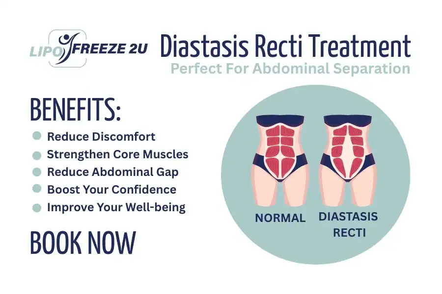 How Long Will It Take to See Improvements in Diastasis Recti Merthyr Tydfil