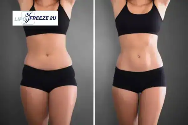 How Can LIPO FREEZE 2U Support Your Post-Pregnancy Body Recovery Merthyr Tydfil?