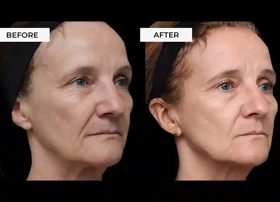 How Many RF Microneedling Sessions Will You Need to See a Difference Merthyr Tydfil?
