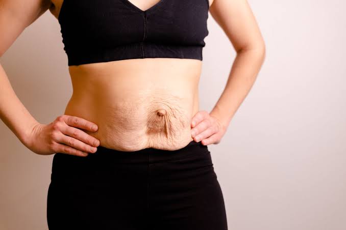 Is Surgery Really the Only Way to Repair Diastasis Recti Merthyr Tydfil?