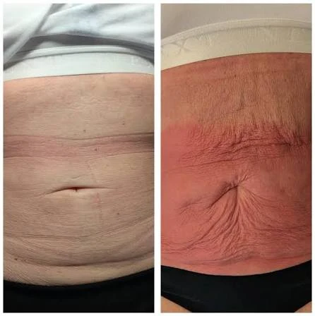 How Does RF Microneedling Improve Crepey, Thin and Uneven Skin Texture Merthyr Tydfil?