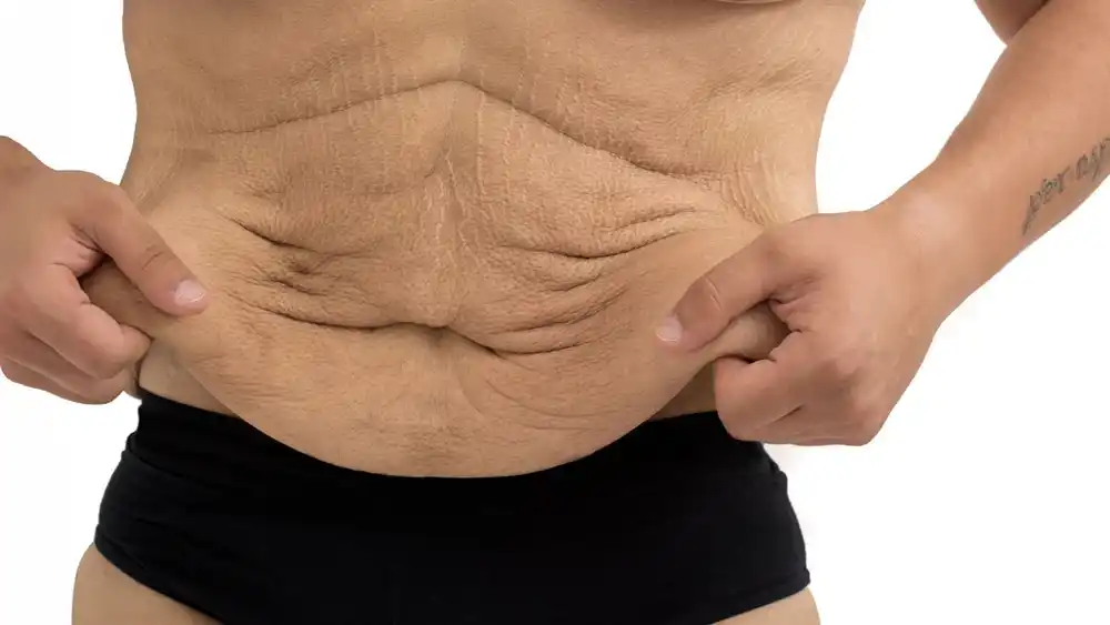 RF Microneedling for Loose Skin: How Can It Help Tighten and Reshape the Skin Merthyr Tydfil?